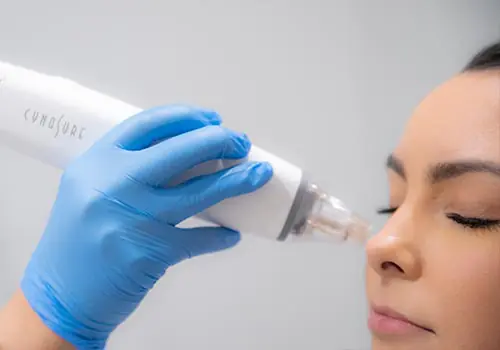 Potenza Microneedling Services