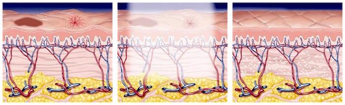 A diagram of the skin before, during, and after an Intense Pulsed Light treatment.