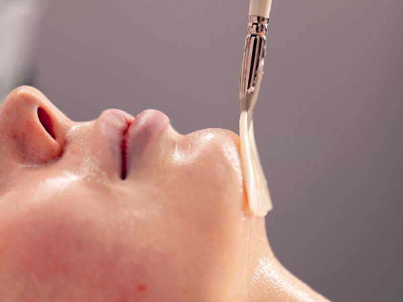 Why Chemical Peels Are the Secret to Anti-Aging and Fine Line Reduction